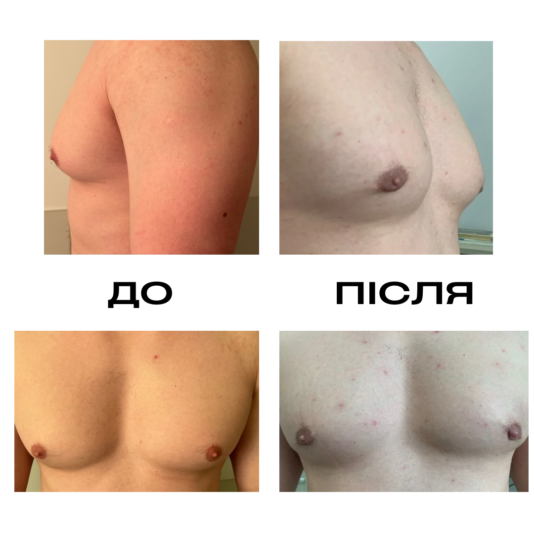 Гінекомастія до/після